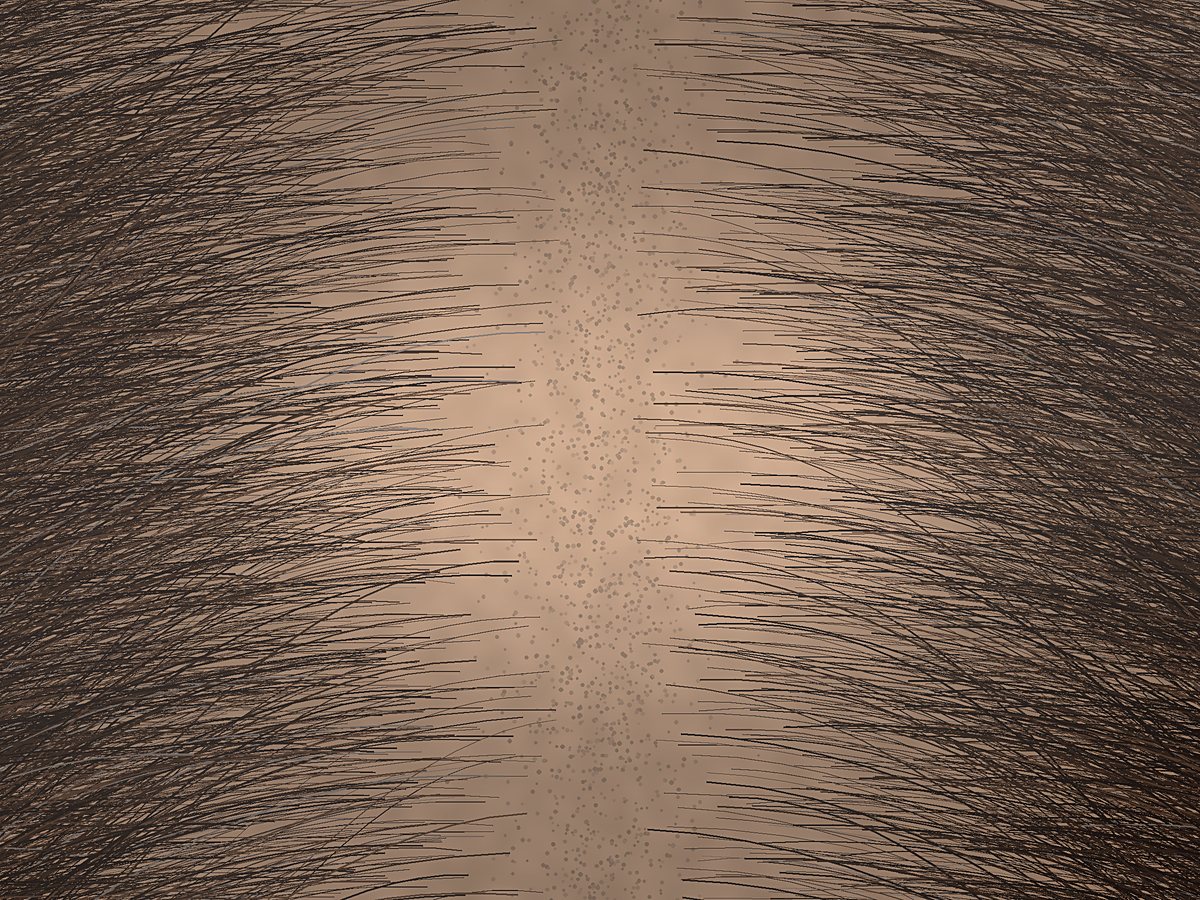 The same scalp at week twelve: the part is roughly half as wide and fine new strands fill in along both edges.