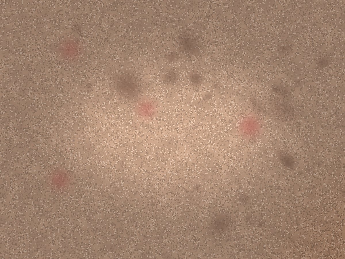 A cheek at week zero, with clustered post-acne dark marks, a few inflamed red spots and uneven tone.
